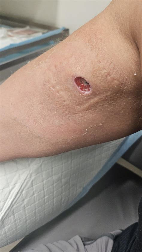 White Tail Spider Bite Symptoms The Redback Spider | Spider Facts