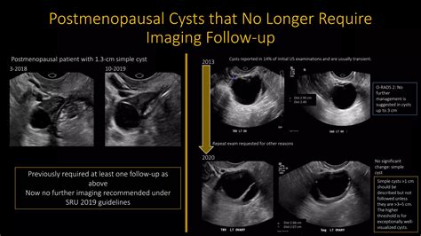 Adnexal cysts.pptx