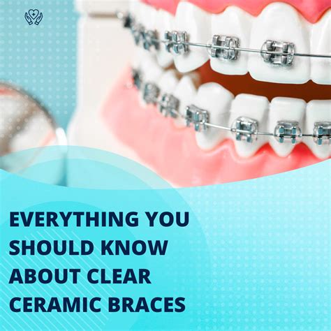 Everything You Should Know About Clear Ceramic Braces ⋆ The Stuff of Success