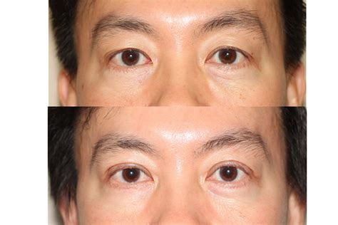 Before and After Asian Double Eyelid Surgery - Dr. Andrew B. Denton