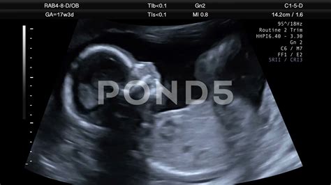 Location Of Baby At 17 Weeks