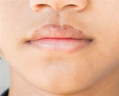6 Food Items To Get Rid Of Dark Lips | Herzindagi