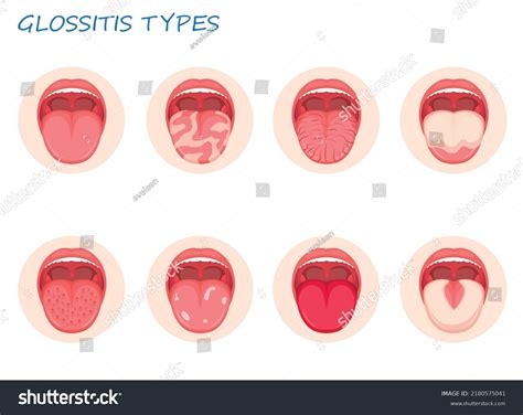 Types Glossitis Tongue Disease Illustration Stock