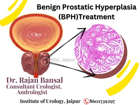 Benign Prostatic Hyperplasia Treatment Current Treatment For Benign