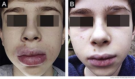 Síndrome de Melkersson‐Rosenthal em crianças e adolescentes: série de sete casos | Anais ...