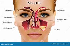 sinusitis 的图像结果