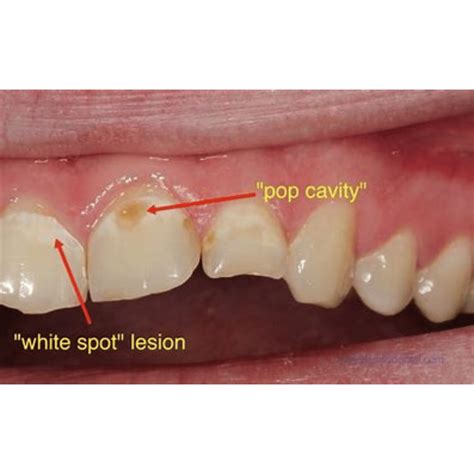 Cavity on Side of Tooth: What It Means and How to Treat It - Smile ...
