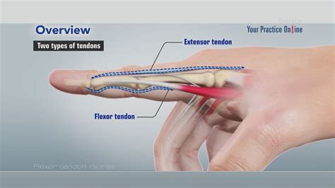 Flexor Tendon Injuries Video | Medical Video Library