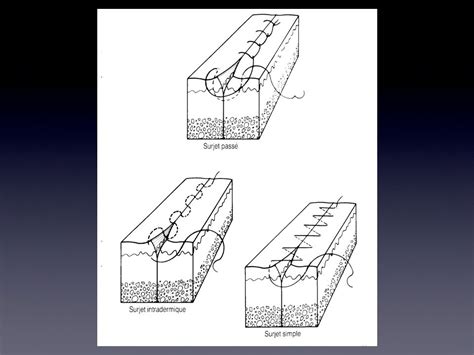 Image result for Surjet Simple Intradermique