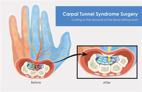 Carpal Tunnel Syndrome | BodyViz Brain Builder