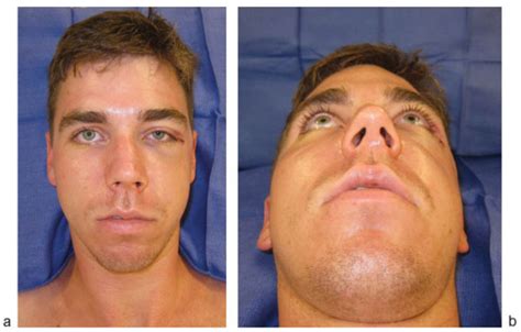 Acute Intraorbital Hemorrhage Following Reduction of a Displaced ...
