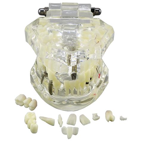 Dentalmall 1 Pc Dental Oral Typodont Model Implant Pathological Anatomy ...