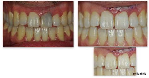 Image result for Grey Tooth