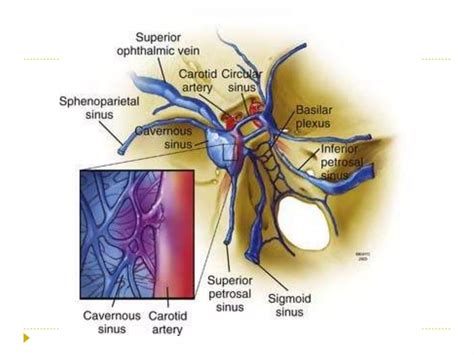 Carotid Cavernous Fistula | PPTX