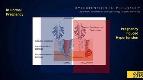 (Eng) pregnancy induced hypertension | PPT