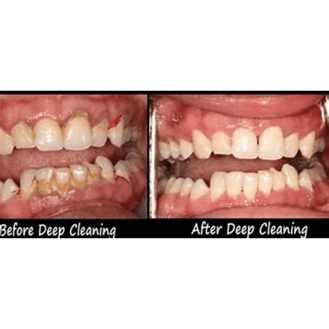 Revolutionize Oral Health with SmileStudio: Why Deep Dental Cleaning is Essential - Smile Studio ...