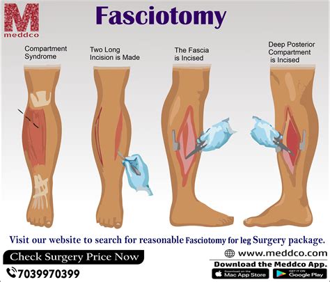 Fasciotomy Rhabdomyolysis