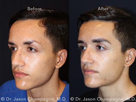Eyebrow Hair Transplantation Gallery | Beverly Hills Plastic Surgeon - Dr. Jason Champagne