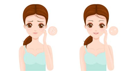 Acne Vs Pimples: What’s The Difference? – AreoVeda