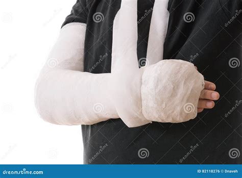 Broken Arm in White Plaster Cast and Sling Stock Photo - Image of ...