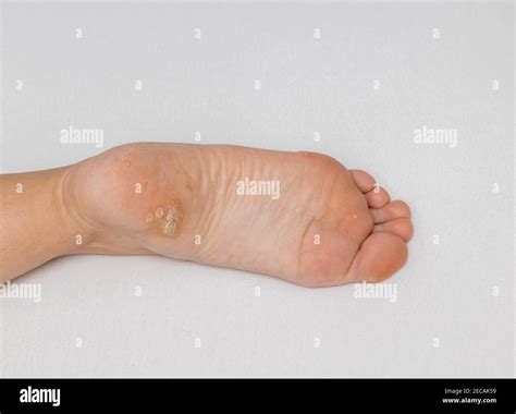 Plantar wart close up on the bottom of a female foot heel caused by the human papillomavirus, or ...