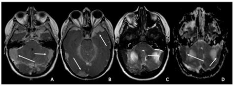 Diffusion Weighted Imaging in Neuro-Oncology: Diagnosis, Post-Treatment ...