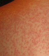 Image result for Penicillium Allergy
