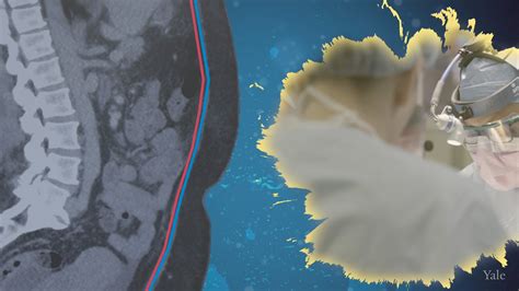 Image result for HIPEC Surgery