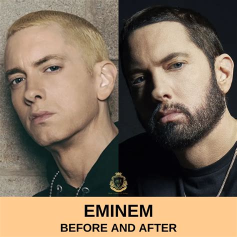 Eminem Hair Transplant - Hair Center of Turkey