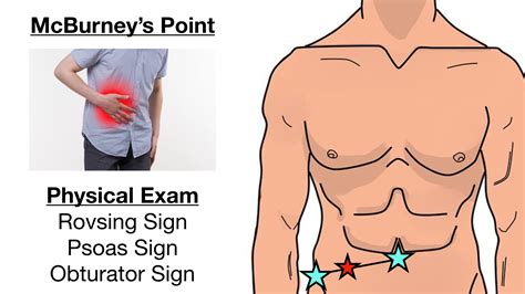Appendicitis Pain Location Diagram