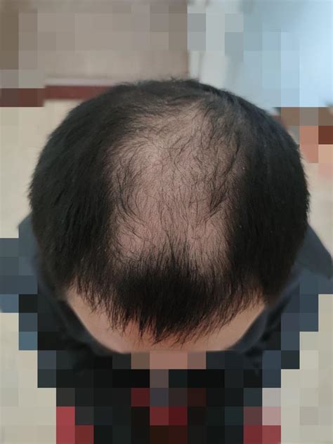 什么是脂溢性脱发？如何预防脂溢性脱发？ - 溢脂性脱发的原因，脱发秃顶怎么办？ 怎么防止脱发？如何生发？植发多少钱？