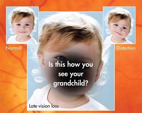 Image result for Macular Degeneration Vision Examples