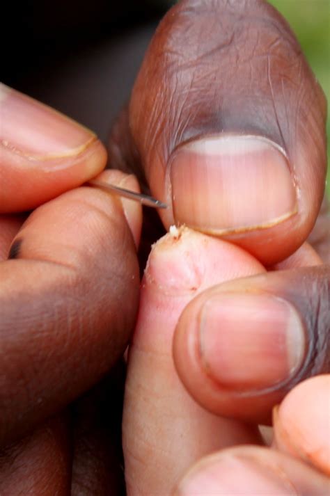 Jigger Fleas Remove 的图像结果