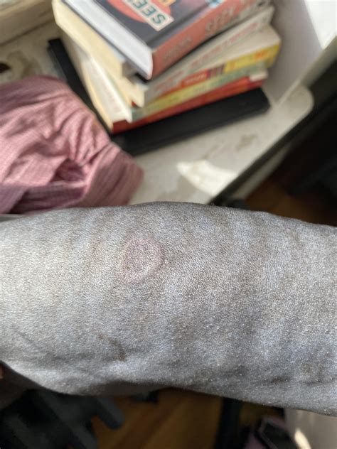 Ringworm on my baby ): help! I have a antifungal mousse and shampoo ...