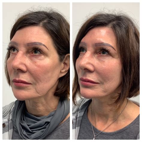 PDO Thread Lift Near Me | Nectar Aesthetics Med Spa