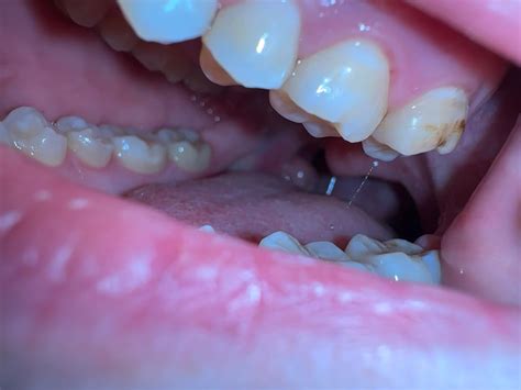 What are these brown spots on my molars and how bad are they? : r/askdentists