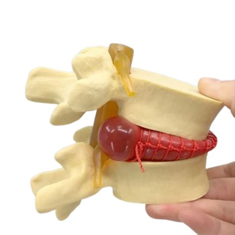 Lumbar Spine Model 1.5x Enlarged for Teaching & Learning | Serplex ...