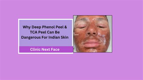 Why Deep Phenol & TCA Peel Is Harmful For Indian Skin Types?