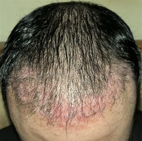 After 2 months i am afraid ..does it look like inflammation ? What do u think about result till ...