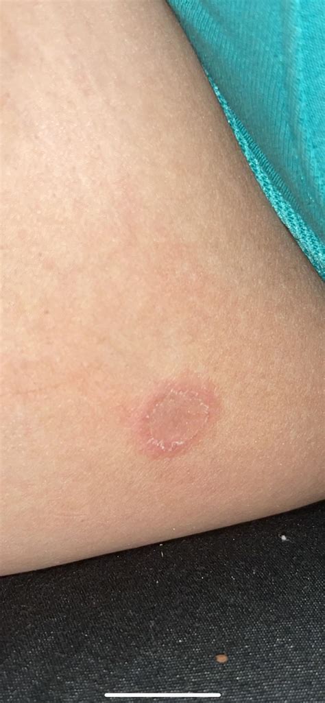 Running Rash On Inner Thigh at Cathy Adler blog