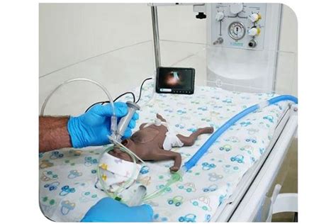 Image result for Neonatal Intubation Procedure