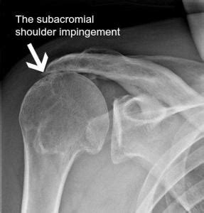 Subacromial Impingement Syndrome | PHYSIOCURE