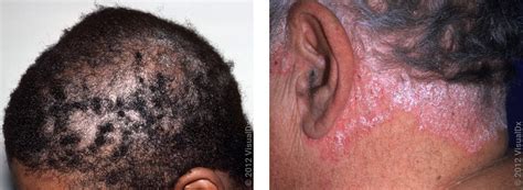 Eczema On Head Under Hair