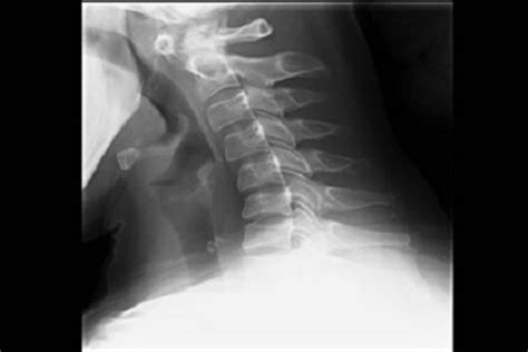 Does X Ray Show Arthritis In Neck at Hunter Wang blog