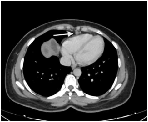 Upper-Abdominal Cytoreduction for Advanced Ovarian Cancer—Therapeutic ...