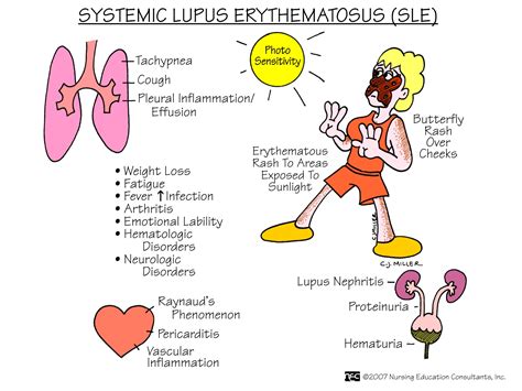 Systemic Lupus Erythematosus: Practice Essentials | Faculty of Medicine