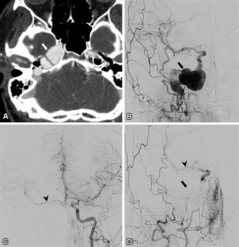 Imaging of Pulsatile Tinnitus | RadioGraphics