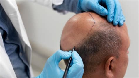 Botched hair transplant leads to engineer's death: Hidden dangers no ...