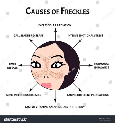 What Causes Freckles