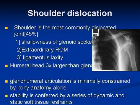 Image result for Sulcus Sign Shoulder Dislocation